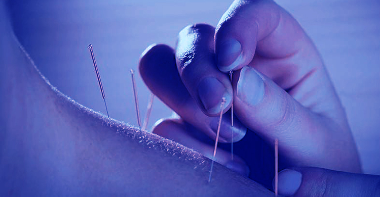 Acupuncture Treatment